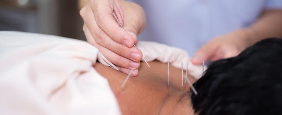 Dry Needling